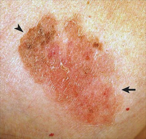 dry skin on nipple|Paget's disease of the breast .